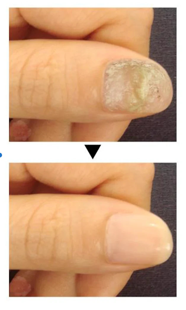 Traitement anti-mycoses des ongles (7 jours)